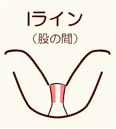 Iライン 股の間 の脱毛 初エッチ対策